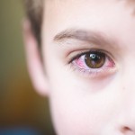 はやり目に感染の原因と治療方法とは?目薬や眼帯は必須?