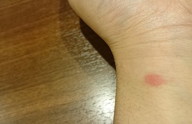 虫に刺された手首